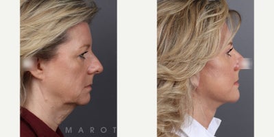 Woman treated with Facelift, Eyelid Surgery - Woman treated with Facelift, Eyelid Surgery