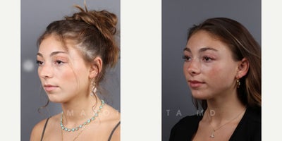 Woman treated with Septoplasty - Woman treated with Septoplasty