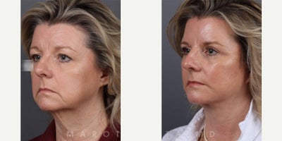 Woman treated with Facelift, Eyelid Surgery - Woman treated with Facelift, Eyelid Surgery