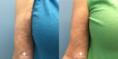 75 and up year old woman treated with Emtone - Improved appearance of skin with decreased irregularities and wrinkles after 4 treatments of Emtone