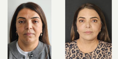 35-44 year old woman treated with Mini Facelift, Chin Liposuction, Mini Neck Lift - mini neck and face lift combined with Vaser neck liposuction