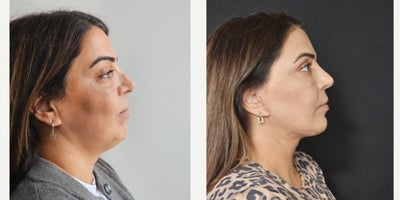 35-44 year old woman treated with Mini Facelift, Chin Liposuction, Mini Neck Lift - mini neck and face lift combined with Vaser neck liposuction
