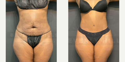 Woman treated with Liposuction - Mother of two desired removal of her excess abdominal skin and repair of rectus diastasis. With lipo 360 and abdominoplasty (tummy tuck with muscle repair) she was able to achieve a thinner waistline, improved back and abdomen contours, and an improved belly button.