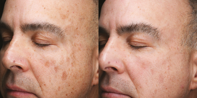 45-54 year old man treated with Halo Laser - 45-54 year old man treated with Halo Laser targeting pigmentation