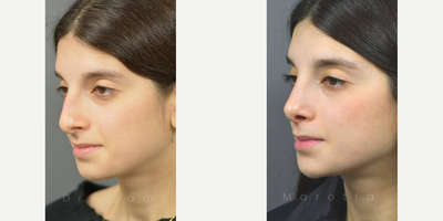 Rhinoplasty - For our patient who just 6 months ago was wondering the same thing.