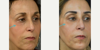 Eyelid Surgery - Woman treated with Eyelid Surgery