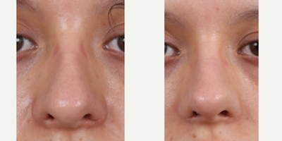 25-34 year old woman treated with Revision Rhinoplasty, Asian Rhinoplasty - 4th revision rhinoplasty, close up photos per patient privacy