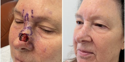 Woman treated with Mohs Surgery - Woman treated with Mohs Surgery by Dr. Bonett at Naples Plastic Surgery.
