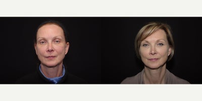 55-64 year old woman treated with Voluma - 56 year old woman treated with Voluma to cheeks; photos depict the patients results 5 weeks post-op.