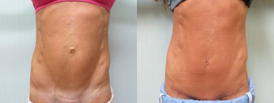 25-34 year old woman treated with Tummy Tuck - This patient had an abdominoplasty with muscle tightening and a floating bellybutton