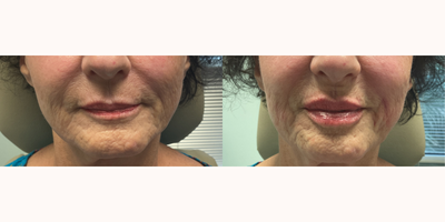 65-74 year old woman treated with Lip Fillers, RHA Collection Fillers - Lip filler to improve volume and hydration of lips
