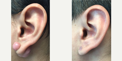 25-34 year old man treated with Scar Removal Keloid - Scar removal for a keloid scar on the earlobe. Keloids can be removed with surgery, injections, and Plato's Scar Serum