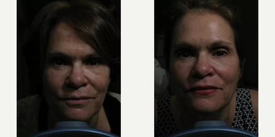 Woman treated with Infini RF - Woman treated with Infini RF