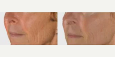 Woman treated with Infini RF - Woman treated with Infini RF