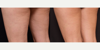 Woman treated with Zimmer ZWave - Hired of dealing with stubborn cellulite? The Z-Wave is the latest in anti-cellulite treatment that uses acoustic wave therapy to drive sound waves into skin that has been affected by dimpling and cellulite (such as the abdomen, upper arms, hips, buttocks and thighs) leaving your skin tighter, smoother and healthier-looking. Z-Wave is a noninvasive cellulite treatment that is pain-free, thus requiring ZERO anesthesia, and ZERO downtime.