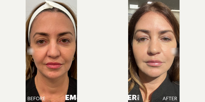 Woman treated with Facial - Woman treated with Facial