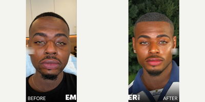 Man treated with Facial - Man treated with Facial