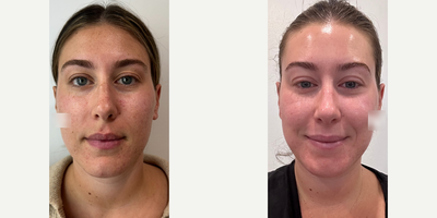 Woman treated with Bellafill - Woman treated with Bellafill