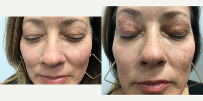 45-54 year old woman treated with Plasma Pen - You can see the immediate tightening from the plasma pen treatment. Tightening improves over 3 months.