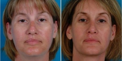 35-44 year old woman treated with Chin Liposuction - Procedure: Submental liposuction, rhinoplasty, scar revision of upper lip, and laser treatment of facial spider veins.