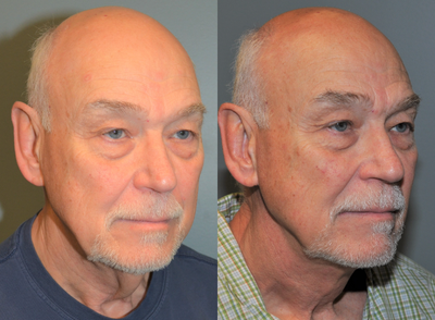 65-74 year old man treated with Neck Lift - This 71 year old gentleman presented requesting improvement in his loose neck tissues only. He is 6'3 tall and weighs 195 lbs. A neck lift with platysma plication, (muscle tightening), was done. His results are shown at six months after his surgery.