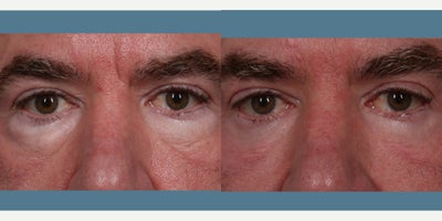 55-64 year old man treated with Eyelid Surgery, Fraxel Repair - 2 year post op and this patient is thrilled. In 2022 our patient had a lower Blepharoplasty with Fraxel Re:pair and fat transfer. Lower Blepharoplasty removes unwanted fat from the lower eyelid to reduce appearance of bags and excess skin is removed to restore a youthful look to the under eye area. When paired with Fraxel Re:pair laser and fat transfer, the youthful appearance is greatly enhanced. Fraxel Re:pair laser stimulates collagen production for a tightening effect. Fat transfer entails extracting fat from another area of the body, purifying the fat, then injecting it into the under eye area. The fat is distributed evenly using expert technique creating a rejuvenated appearance.