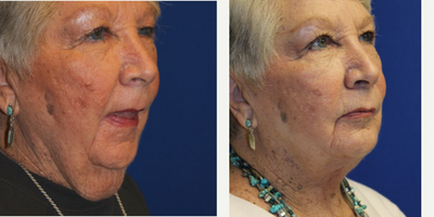 65-74 year old woman treated with Direct Submentoplasty Direct Neck Lift - This patient presented with very heavy neck. Conventional face lift may not be able to achieve the result she was looking for. While direct submentoplasty may not be for everyone, for a selected patient with a very heavy turkey gobler neck, this is a very effective technique. She also had extensive neck skin crease which allowed me to blend in the midline neck scar with a Z-plasty.