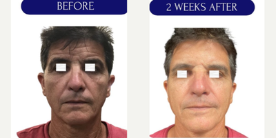 55-64 year old man treated with Radiesse, Dermal Fillers, Collagen Injection, Skin Tightening, Skin Rejuvenation, Sculptra, Nons - Collagen biostimulation with DILUTED RADIESSEHyperdiluted Radiesse is Radiesse that has been diluted with a mixture of sterile saline solution and lidocaine. This makes it an easily spreadable bio stimulator capable of remodeling skin over a larger area. Hyperdiluted Radiesse is injected into areas of the skin that are loose as opposed to firm and stimulates the body to create new collagen. It is used to address concerns related to skin texture and laxity, such as fine wrinkles, creepiness, acne scars, cellulite, and saggy skin.