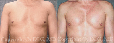 48 Year Old Male With Pec Implants - This 48 year-old gentleman desired more chest muscle definition and bulk than he was able to achieve at the gym (and he did not want to use anabolic steroids). He came to Dr. Gervais at Minneapolis Plastic Surgery for pec implants, which gave him improved chest appearance, and also inspired him to continue working harder at the gym to obtain better abs and lower body fat weight. We used a soft cohesive solid silicone implant through a anterior axillary fold incision in the sub-muscular position. His post-op photos are at 6 months