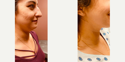 Woman treated with Nonsurgical Facelift - Face lift, Chin lift with acne scar reduction via Evoke