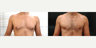 43 year old man treated with Gynecomastia Surgery - This male patient aged 43 was treated with gynecomastia surgery, where a mastectomy is used to remove enlarged male breast tissue. The after photo was taken 2 months post-surgery.