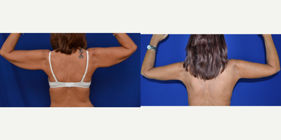 35-44 year old woman treated with Arm Lift - Arm lift