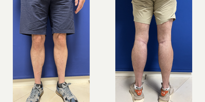 56 year old man treated with Calf Implants - Patient wanted calf augmentation with implants. After selecting appropriate implants shape and volume we proceeded with calf augmentation surgery. Implants were placed underneath the muscle fascia covering a medial head of gastrocnemius muscle. Incision, scar was placed in the po[pliteal (knee) crease. Patient is shown before and 10 months after surgery.