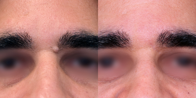 35-44 year old man treated with Mole Removal, Dermabrasion, DeepFX, Vbeam - For more information on this procedure, please visit: https://www.drkhorasani.com/before-and-after-gallery/cosmetic-mole-removal
