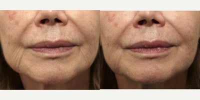 74 year old woman treated with RHA Collection Fillers - 74 year old female complaining about the creases visible lateral to her lips. These lines were improved with the use of 1 syringe of RHA Redensity hyaluronic acid injectable filler.