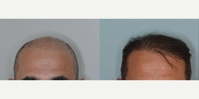 55-64 year old man treated with FUE Hair Transplant, Hair Transplant - Revision of a prior hair transplant done elsewhere. 2,100 FUR graft to create density and conceal prior hair transplant.