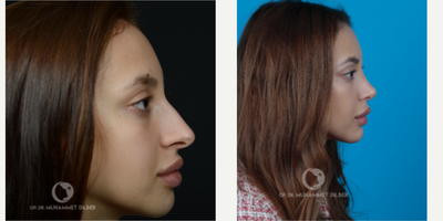 18-24 year old woman treated with Rhinoplasty - Another beautiful result after primary rhinoplasty