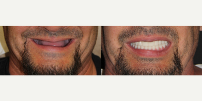 All-on-4 Dental Implants - All-on-4 Dental Implants