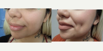 18-24 year old woman treated with Dimple Surgery - This patient underwent our customized Timeless Dimple (dimpleplasty) to enhance and complement their individual facial expression and features.