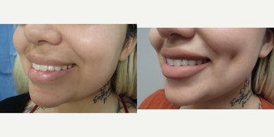 18-24 year old woman treated with Dimple Surgery - This patient underwent our customized Timeless Dimple (dimpleplasty) to enhance and complement their individual facial expression and features.