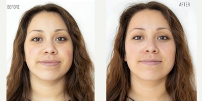 Woman treated with HydraFacial - Before & After, HydraFacialThe indulgent and hydrating HydraFacial is a skin non-invasive, serum based resurfacing procedure that is suitable for all skin types.