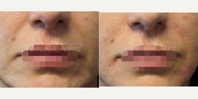 45-54 year old gender nonconforming person treated with Juvederm, Vollure, Restylane - Treatment of nasolabial folds (laugh lines) and marionette lines with Juvederm, Radiesse, Vollure, Restylane or Bellafill injected with cannula