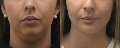 Chin Filler - 18-24 year old woman treated with Chin Filler