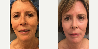 65-74 year old woman treated with Laser Peel - One month after full face and neck laser treatment in our office operating suite under sedation.