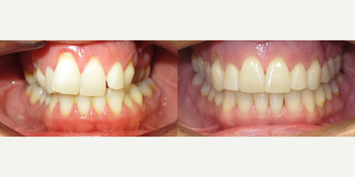 25-34 year old woman treated with Clear Braces - Overbite, crossbite, 24 months treatment with Clear Braces