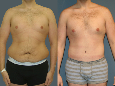 Male tummy tuck - 
	Male tummy tuck with flank liposuction and excision

