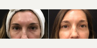 45-54 year old woman treated with Agnes RF - 45-54 year old woman treated with Agnes RF