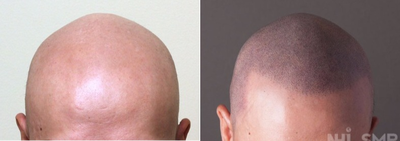 25-34 year old man treated with Hair Loss Treatment Scalp MicroPigmentation SMP - Scalp MicroPigmentation SMP