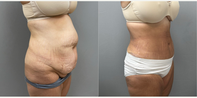 Woman treated with Tummy Tuck - Tummy Tuck