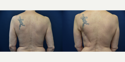 55-64 year old woman treated with Breast Reconstruction with Latissimus Flap - This patient is 13 weeks out from latissimus dorsi flap by Dr. Leveque. Skin, fat, muscle, and blood vessels from upper back were used to reconstruct the breast after breast cancer.